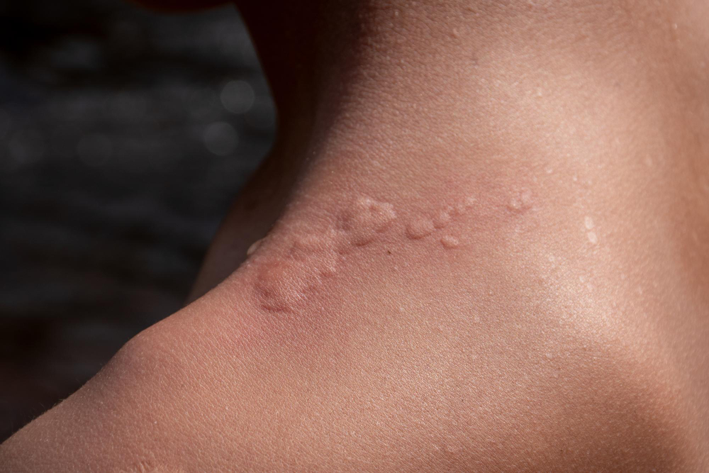 hipertrofična brazgotina